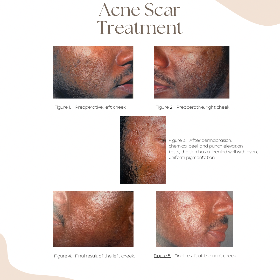Treatment of Large Pores on the Nose and Central Face | Colorado ...